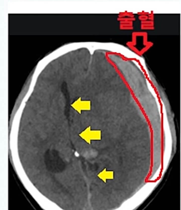 뇌출혈-CT-사진-출혈된-사진